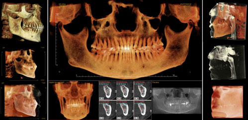3D Dental Implant
