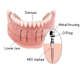 How Mini-Implants Work