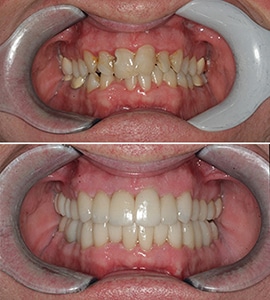 Dental Implants Savannah Patient