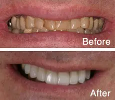 veneersbefore-thumb-230xauto-51.jpg