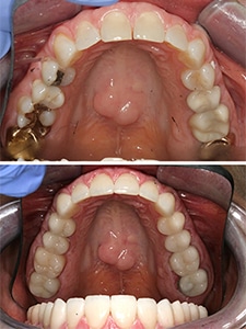 white-fillings-patient Close up of patient's teeth before and after replacing metal fillings with tooth colored fillings