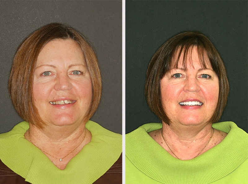 before & after picture of a patient of Beyond Exceptional Dentistry