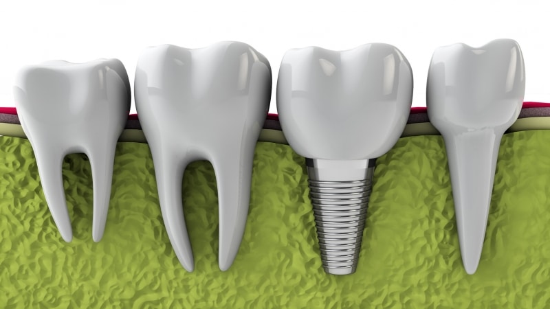 Dental implants can last a long time