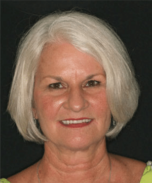 Dolores' smiling portrait after dental treatment