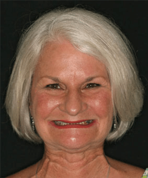 Delores' smiling portrait before dental treatment