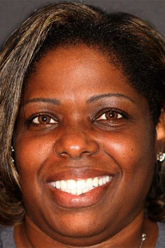 Patient smiling after VitaSmile