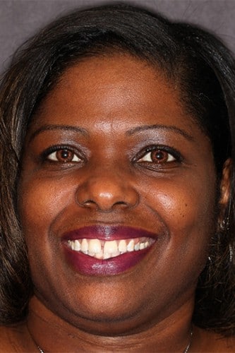 Patient smiling with spaced teeth before VitaSmile