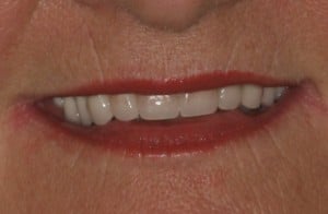 Close up of Delore's smile after dental treatment