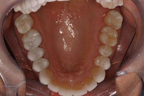 Patient's tooth colored fillings after dental treatment