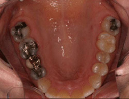 Metal Amalgam Fillings Can Increase Your Tooth Sensitivity