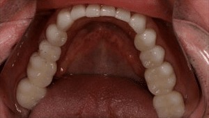 Close up of patient's whitened smile after dental treatment replaces metal fillings with tooth colored fillings