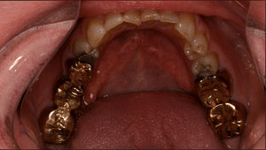 Close up of patient's lower metal fillings before dental treatment