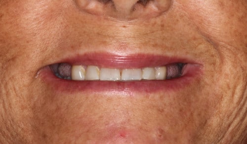 Close up of Patrice's smile before dental treatment for discoloration