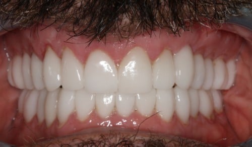 Close up of Frank's white, straight smile after dental treatment