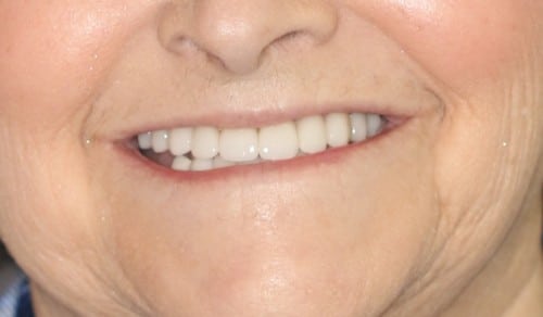 Close up of Jean's smile after dental treatment for discoloration and gaps