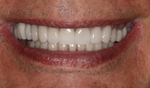 Close up of Robert's bright and straight smile after dental treatment