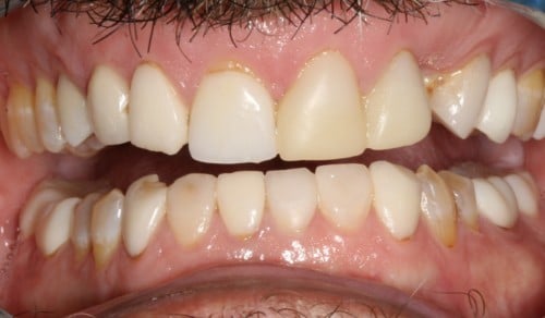 Close up of Frank's smile before dental treatment for discoloration and crookedness