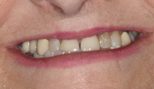 Close up of Jean's discolored and gapped smile before dental treatment
