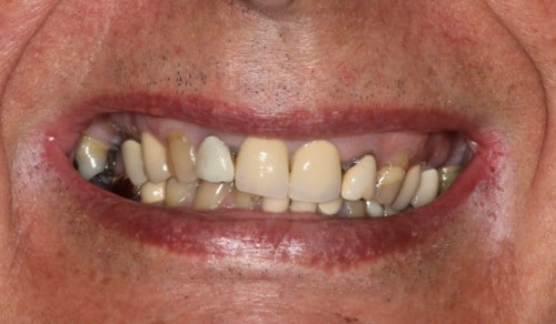 Close up of Robert's crooked and discolored teeth before dental treatment