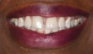Close up of patient smile before VitaSmile fixes mercury fillings and cracked teeth