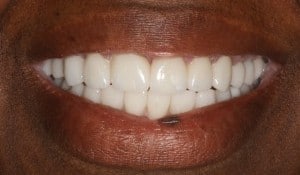 Patient smiling after VitaSmile fixes mercury fillings and cracked teeth