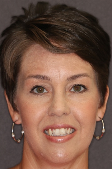 Female dental patient at Beyond Exceptional Dentistry displays her crooked teeth