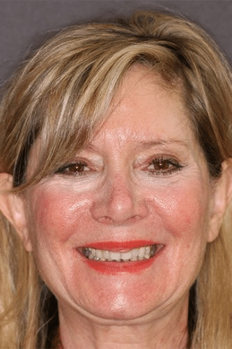 female dental patient of Beyond Exceptional Dentistry shows off her teeth before treatment