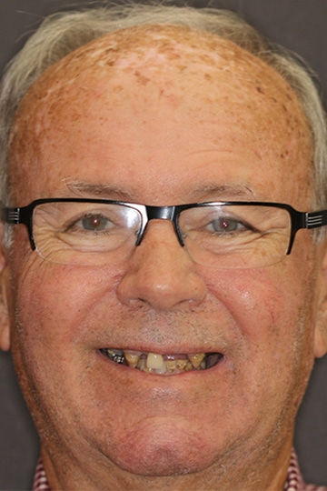 A male dental patient of Savannah's cosmetic dentists before treatment for missing teeth