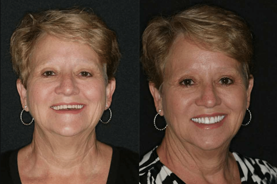 FOY Dentures patient FOY Dentures patient