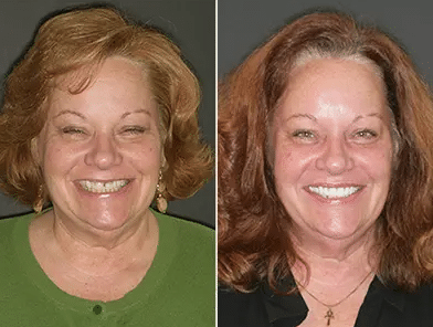 FOY® Dentures patient