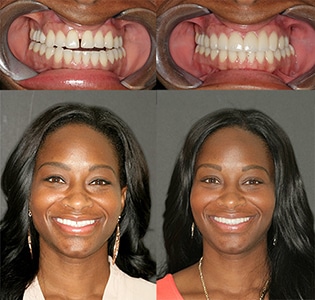 Before and after porcelain veneers transformation