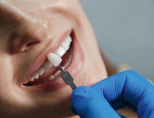 How Long Do Veneers Last? Everything You Need to Know in 2025