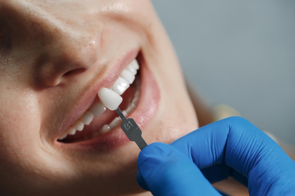 Close-up of a dentist using a color guide to match the shade of a dental veneer