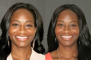 porcelain-veneers