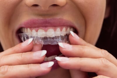 Close-up of a woman wearing transparent dental braces