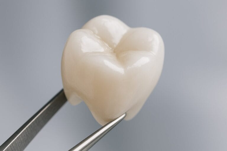 How Long Do Dental Crowns Last? What Savannah Dentists Say in 2026