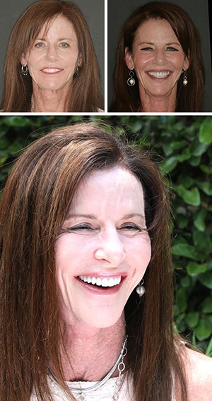 before and after results of full mouth reconstruction, patient of Beyond Exceptional Dentistry 