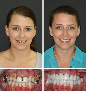 Patient's smile before and after dental treatment