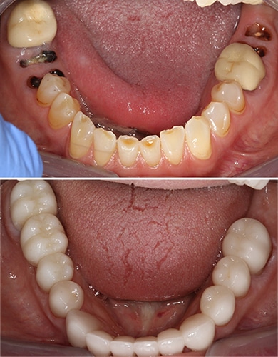 Dental Implant Benefits Savannah, GA