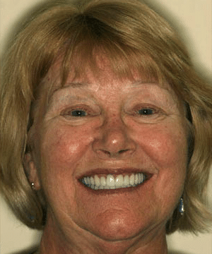 Mary's smiling portrait after dental treatment