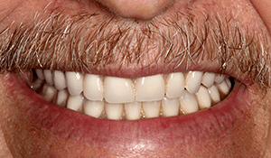 Close up of patient's smile after dental treatment