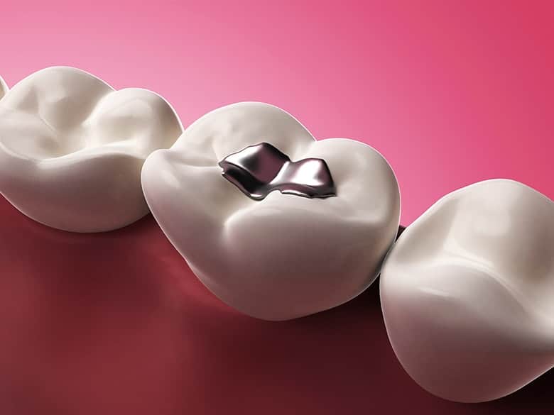 The Complete Guide to Replacing Metal Fillings