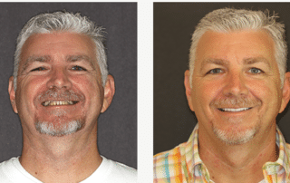 Patient's smile before and after FOY® Dentures