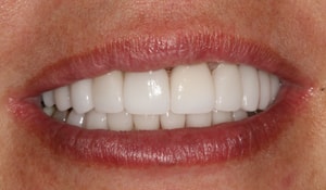 Close up of Courtney's bright white smile after dental treatment