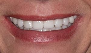 Close up of Kelly's bright and straight smile after dental treatment