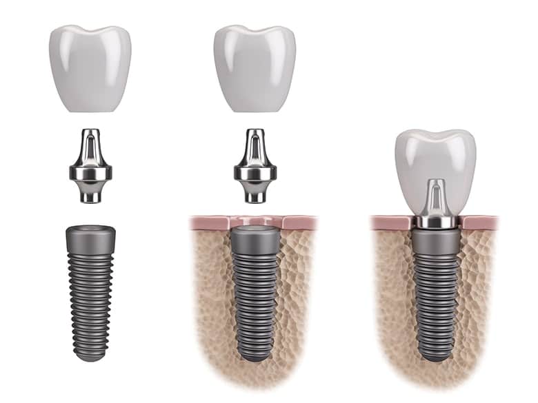 Why Replace Dental Implant Crowns | Beyond Exceptional Dentistry