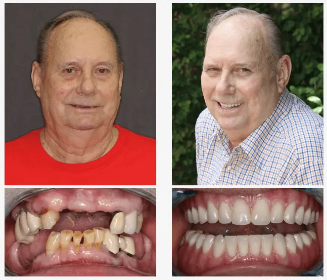 John came to us wanting to have a healthy stable smile. We were able to give him that with 4 lower snaps and upper and lower FOY’s. He is now able to eat corn on the cob and still enjoy his popcorn every night. He came in with a clean corn cob that he ate himself and enjoyed every kernel!