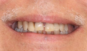Close up of Rusty's teeth before dental treatment for yellow, gapped, and crowded teeth
