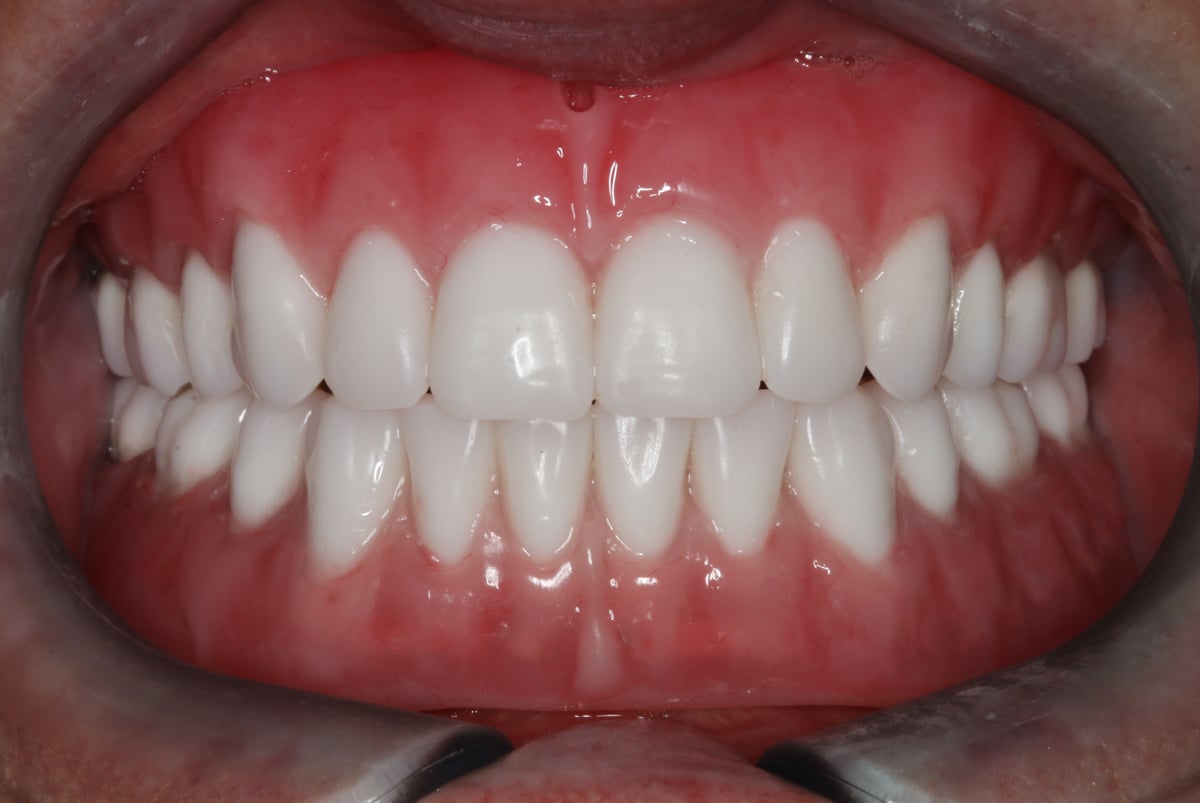 Patient smile after FOY® Dentures