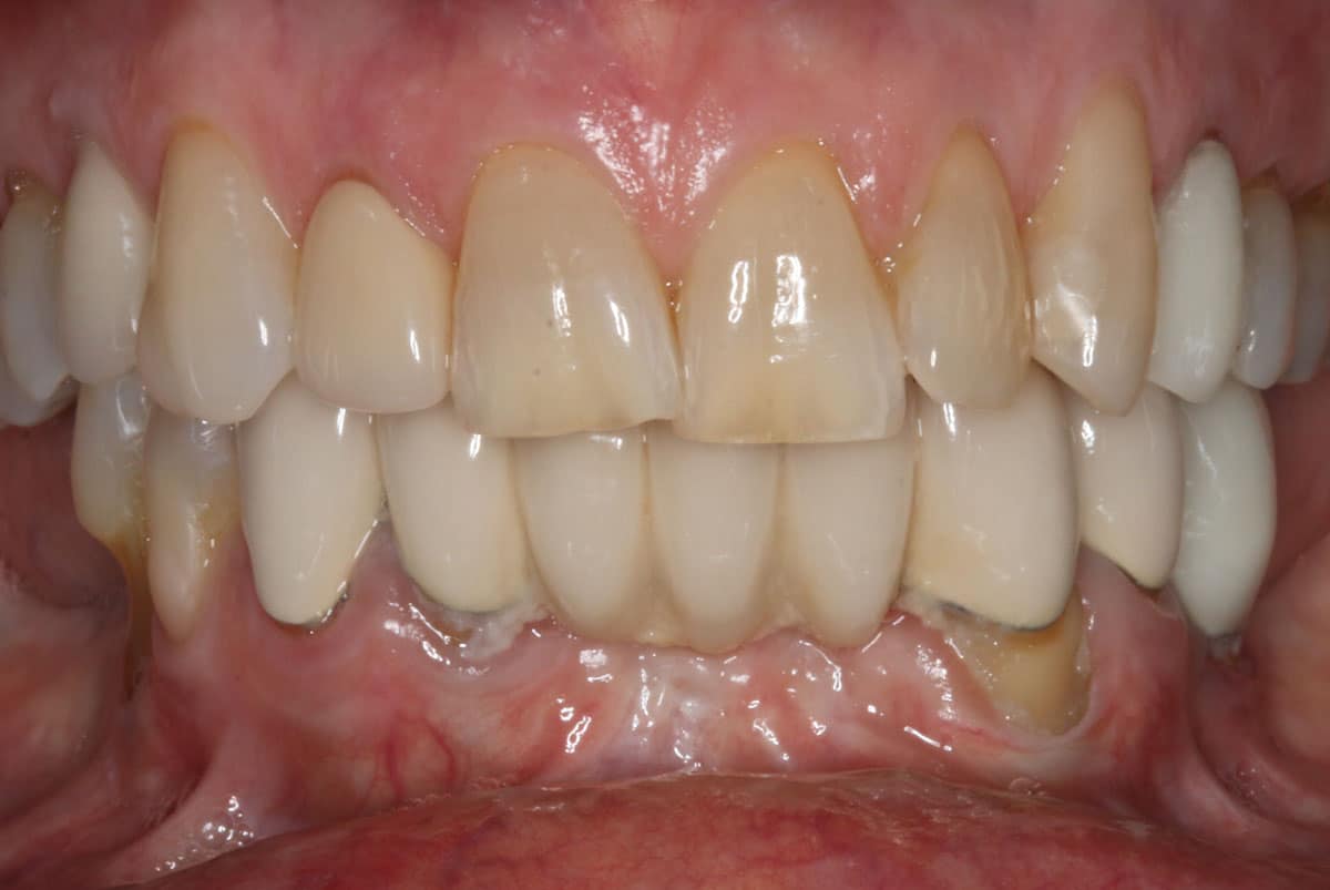 Close up of teeth before neuromuscular treatment, customized gum therapy, and a smile makeover